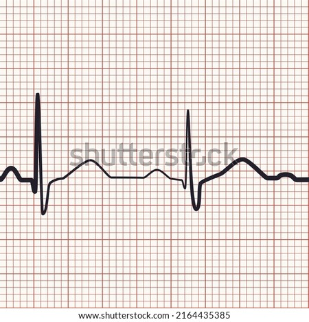 Electrocardiogram seamless background. Heart beat rate recording on pink ekg paper. Millimeter graph and curve of cardiology rhythm. Medical vector design for hospital page, banner