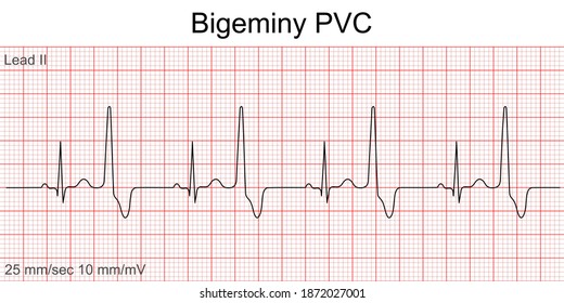 Electrocardiogram show Bigeminy PVC pattern ,Heart beat ,ECG ,EKG  interpretation ,Vital sign ,Life line ,Medical healthcare symbol.