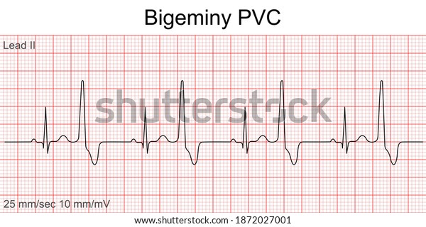 Electrocardiogram Show Bigeminy Pvc Pattern Heart Stock Vector Royalty Free