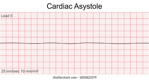 Electrocardiogram show Cardiac asystole pattern. Cardiac fibrillation. Heart beat. CPR. ECG. EKG. Vital sign. Life support. Defib. Emergency. Medical healthcare symbol.