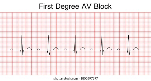 Electrocardiogram show first degree AV block pattern. ECG. EKG. Vital sign. Heart beat. Life line. Medical healthcare symbol.