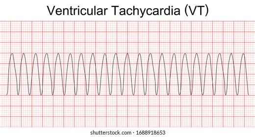 Electrocardiogram show monomorphic ventricular tachycardia (VT). Cardiac fibrillation. Heart beat. CPR. ECG. EKG. Vital sign. Life support. Medical healthcare symbol.