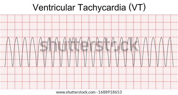 Electrocardiogram Show Monomorphic Ventricular Tachycardia Vt