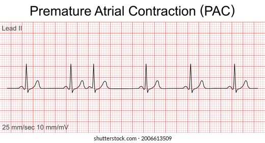 Electrocardiogram show Premature Atrial Contraction (PAC) pattern ,Heart beat ,ECG ,EKG interpretation ,Vital sign ,Life line ,Medical healthcare symbol.