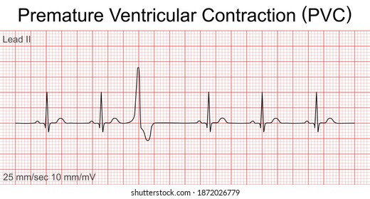 Electrocardiogram show Premature Ventricular Contraction (PVC) pattern ,Heart beat ,ECG ,EKG interpretation ,Vital sign ,Life line ,Medical healthcare symbol.