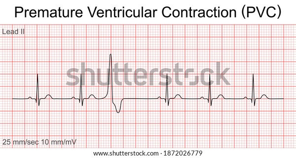 premature atrial contraction strip