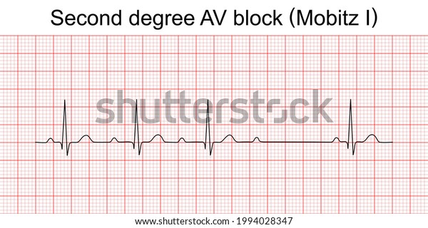 Electrocardiogram Show Second Degree Av Block Stock Vector (Royalty ...