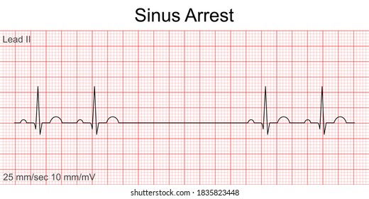 Electrocardiogram show Sinus arrest pattern. Cardiac fibrillation. Heart beat. CPR. ECG. EKG. Vital sign. Life support. Defib. Emergency. Medical healthcare symbol.