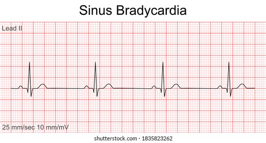 Electrocardiogram show Sinus bradycardia pattern. Cardiac fibrillation. Heart beat. CPR. ECG. EKG. Vital sign. Life support. Defib. Emergency. Medical healthcare symbol.