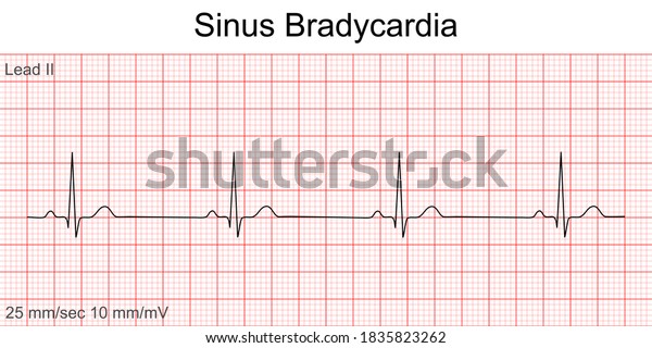 Electrocardiogram Show Sinus Bradycardia Pattern Cardiac Stock Vector ...