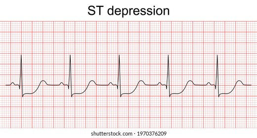 Electrocardiogram show ST segment depression pattern. Heart attack. Ischemic. Coronary artery disease. Angina pectoris. Chest pain. ECG. EKG. Medical health care.