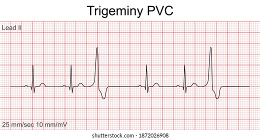 Electrocardiogram show Trigeminy PVC pattern ,Heart beat ,ECG ,EKG interpretation ,Vital sign ,Life line ,Medical healthcare symbol.
