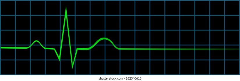 Electrocardiogram Showing Last Normal Heart Beat And No Life Sign