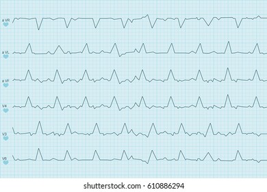 Electrocardiogram test results. Curves on blue paper. Vector illustration