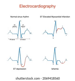 Electrocardiography Ecg Ekg Heart Normal Sinus Stock Vector (Royalty ...