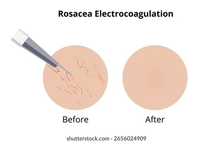 Electrocoagulación extirpando las venas de la rosácea cuperosa antes y después del tratamiento