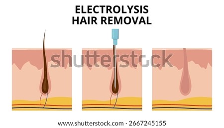 Electrolysis hair removal process showing probe inserting into hair follicle