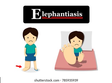Elephantiasis in flat cartoon, vector design