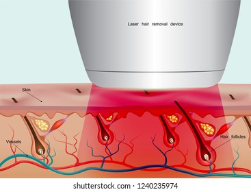 To eliminate hair follicles with laser hair removal