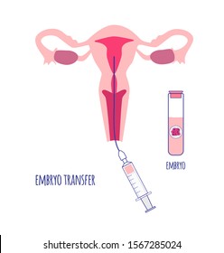 Embryo transfer by syringe with catheter. Egg donation. In vitro fertilization.Vector illustration.