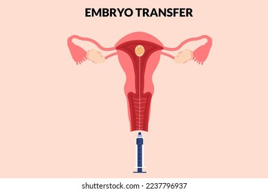 Embryo transfer with Embryon and uterus, Embryo transfer by syringe In vitro fertilization. Vector illustration.