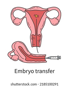 Transferencia de embriones al útero de la mujer en la fertilización in vitro IF ilustración vectorial en el estilo dibujado a mano de doodle