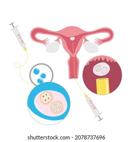 Embryo transfer is the linal step in the in vitro fertilization (IVF) journey