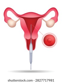 Embryo transfer procedure used during IVF fertility treatment, showing a thin catheter passing through the cervix into the uterus with a magnified reproductive cell illustration. Suitable for assisted reproduction, fertility clinics, reproductive medicine, infertility treatment, gynecology, embryology, pregnancy planning, and medical education. 3d illustration