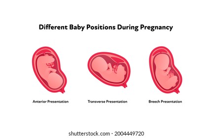 Embryo in womb medical diagram. Vector flat healthcare illustration. Different baby position during pregnancy. Anterior, transverse, breech. Design for health care, education.