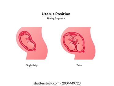 Embryo in womb medical diagram. Vector flat healthcare illustration. Uterus position during pregnancy. Single baby and twins. Design for health care, education.
