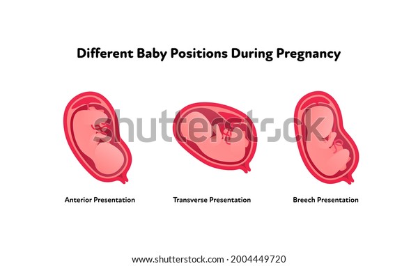 Embryo in womb\
medical diagram. Vector flat healthcare illustration. Different\
baby position during pregnancy. Anterior, transverse, breech.\
Design for health care,\
education.