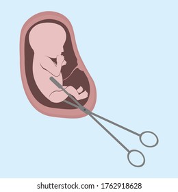An embryo in the womb and surgical forceps. Abortion is a personal decision of each person. Flat vector illustration. Concept of abortion.