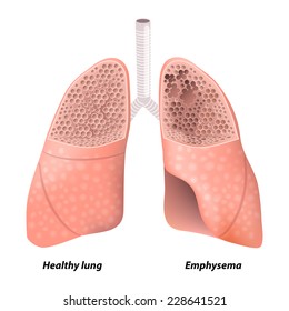 Emphysema. Chronic Obstructive Pulmonary Disease. Diagram Showing A Cross-section Of Normal Lung And Lungs Damaged By COPD. Human Anatomy