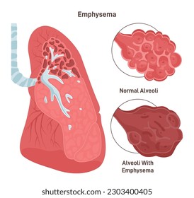 Emphysema. Chronic obstructive pulmonary disease caused by smoking. Cross-section of normal alveoli and alveoli walls damaged by COPD. Dangers of nicotine. Flat vector illustration