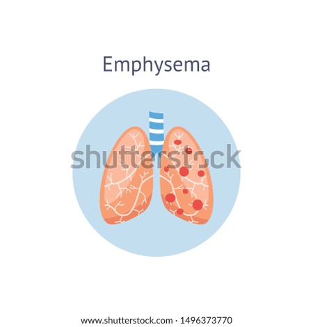 Emphysema chronic obstructive pulmonary disease diagram showing a cross-section of normal lung and lungs damaged by COPD, vector illustration isolated on white background.