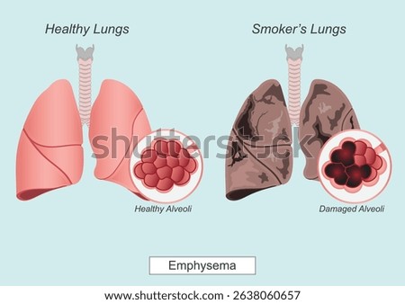 Emphysema is a chronic obstructive pulmonary disease that damages the air sacs in lungs and makes it hard to breathe.Group of diseases known as chronic obstructive pulmonary disease (COPD). 