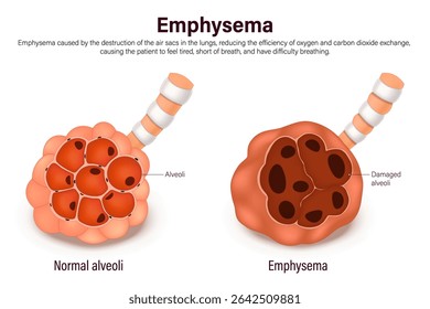 Enfisema. Comparação entre alvéolos normais e enfisema. Anatomia de doenças pulmonares. Sistema respiratório humano.