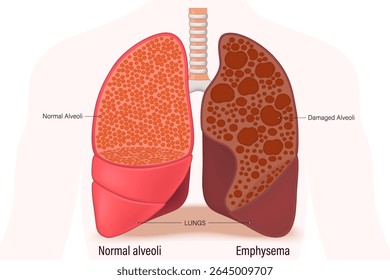 Enfisema. Comparação entre alvéolos normais e enfisema. Anatomia de doenças pulmonares. Sistema respiratório humano.