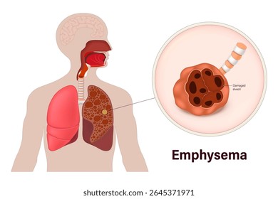 Enfisema. Alvéolos danificados. Anatomia de doenças pulmonares. Sistema respiratório humano.
