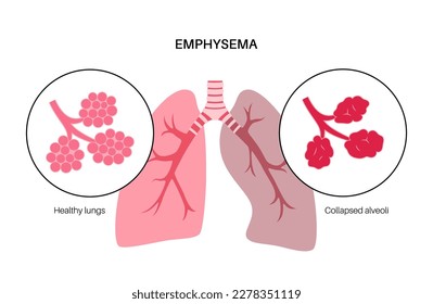 Emphysema disease concept. Damaged alveoli, failure airway. Floppy walls between air sacs in human lungs. Shortness of breath, chest tightness. Illness of respiratory system flat vector illustration