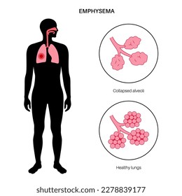 Emphysema disease concept. Damaged alveoli, failure airway. Floppy walls between air sacs in human lungs. Shortness of breath, chest tightness. Illness of respiratory system flat vector illustration