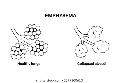 Concepto de enfermedad emfilémica. Alveoli dañado, vía aérea de falla. Disparos entre sacos de aire en pulmones humanos. Falta de aliento, opresión torácica. Enfermedad del sistema respiratorio ilustración vectorial plana