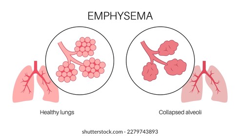 Emphysema disease concept. Damaged alveoli, failure airway. Floppy walls between air sacs in human lungs. Shortness of breath, chest tightness. Illness of respiratory system flat vector illustration