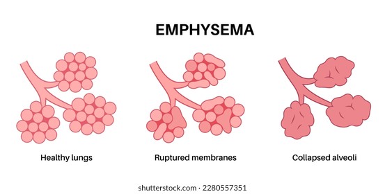 Emphysema disease concept. Damaged alveoli, failure airway. Floppy walls between air sacs in human lungs. Shortness of breath, chest tightness. Illness of respiratory system flat vector illustration