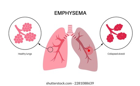 Emphysema disease concept. Damaged alveoli, failure airway. Floppy walls between air sacs in human lungs. Shortness of breath, chest tightness. Illness of respiratory system flat vector illustration