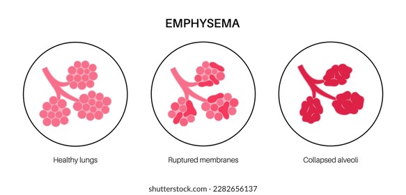 Emphysema disease concept. Damaged alveoli, failure airway. Floppy walls between air sacs in human lungs. Shortness of breath, chest tightness. Illness of respiratory system flat vector illustration