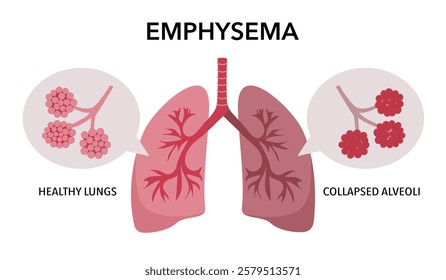 Emphysema disease concept. Damaged alveoli, failure airway. Floppy walls between air sacs in human lungs. Shortness of breath, chest tightness. Illness of respiratory system flat vector illustration