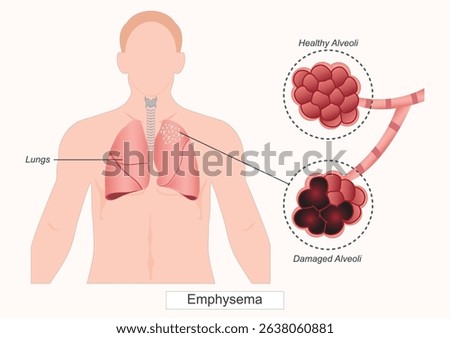 Emphysema is a long-term lung condition that causes shortness of breath.that is part of a group of diseases known as chronic obstructive pulmonary disease (COPD).Medical Health care, vector 