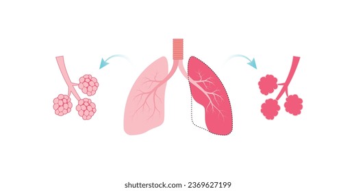 Emphysema Lung Disease Concept Design. Vector Illustration.