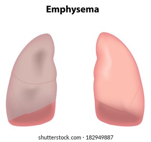 Emphysema Lungs